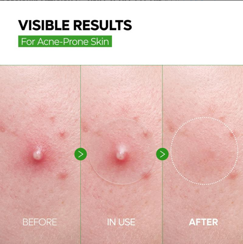 Lumora Ultra Thin Blemish Spot Patch